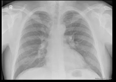 Asbestos Disease Claims